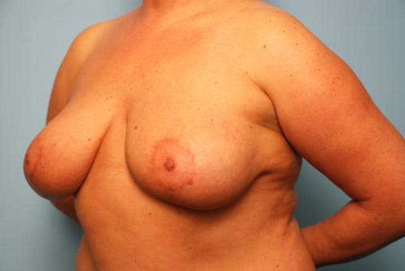 Breast Lift Before & After Gallery - Patient 422335 - Image 8