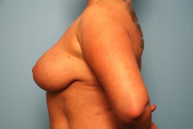 Breast Lift Before & After Gallery - Patient 422335 - Image 10