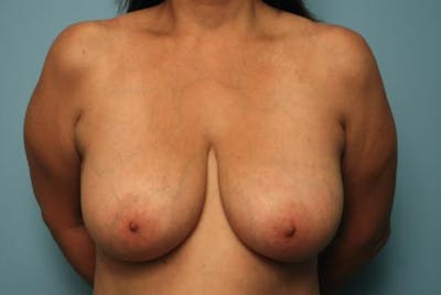 Breast Lift Before & After Gallery - Patient 684336 - Image 1