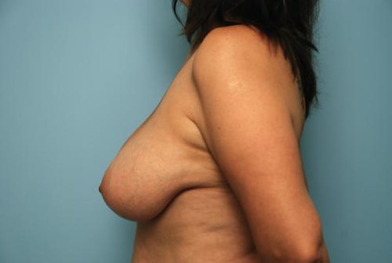 Breast Lift Before & After Gallery - Patient 162486 - Image 9