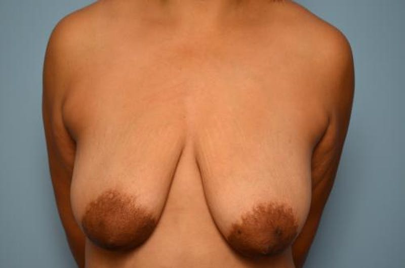 Breast Lift Before & After Gallery - Patient 195580 - Image 1