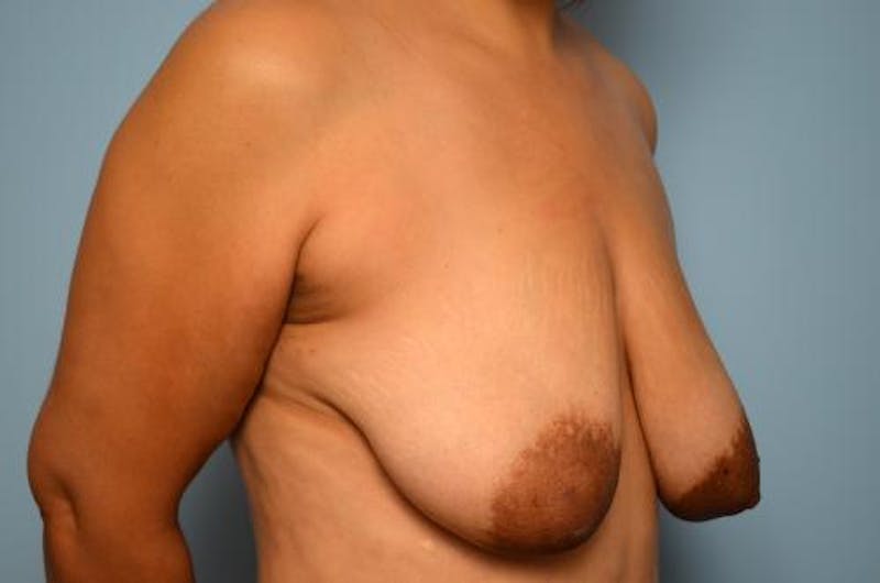 Breast Lift Before & After Gallery - Patient 195580 - Image 3