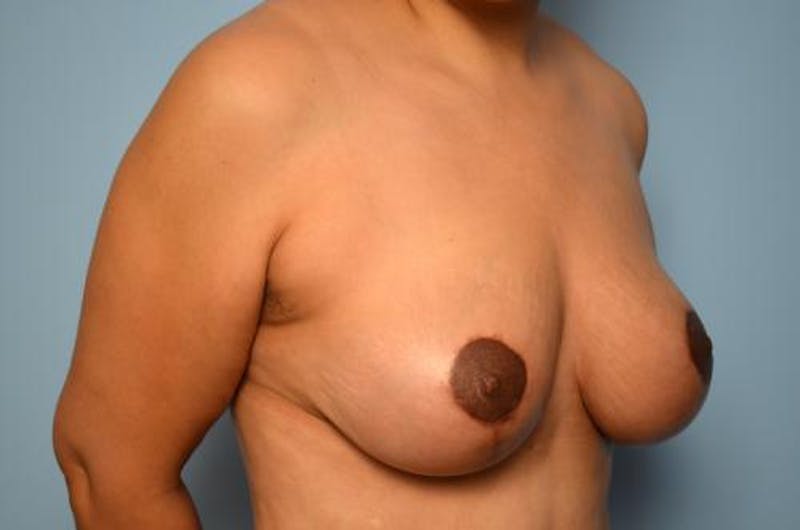 Breast Lift Before & After Gallery - Patient 195580 - Image 4