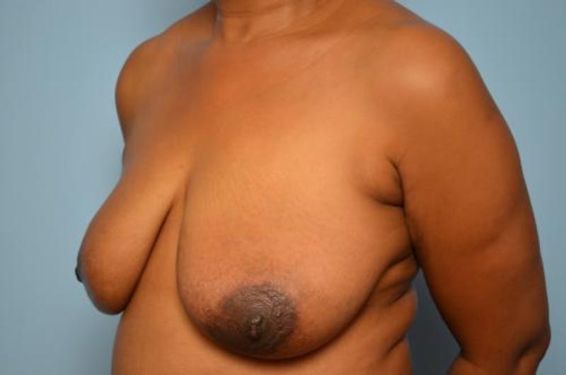 Breast Lift Before & After Gallery - Patient 266060 - Image 7