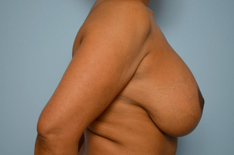 Breast Implant Exchange Before & After Gallery - Patient 281748 - Image 5