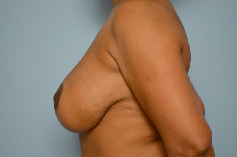 Breast Implant Exchange Before & After Gallery - Patient 281748 - Image 9