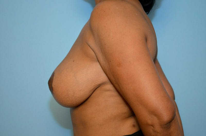 Breast Implant Exchange Before & After Gallery - Patient 281748 - Image 10
