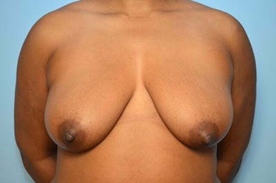 Breast Lift Before & After Gallery - Patient 168229 - Image 1