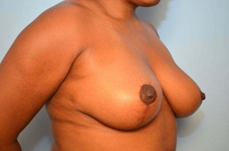 Breast Lift Before & After Gallery - Patient 124677 - Image 4