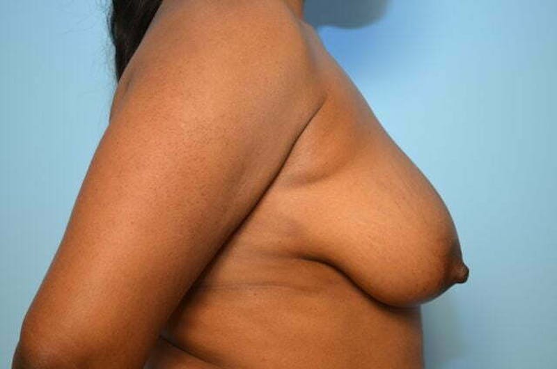 Breast Lift Before & After Gallery - Patient 124677 - Image 5