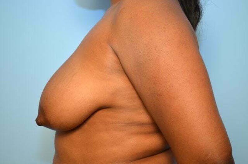 Breast Lift Before & After Gallery - Patient 124677 - Image 9