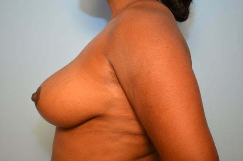 Breast Lift Before & After Gallery - Patient 124677 - Image 10