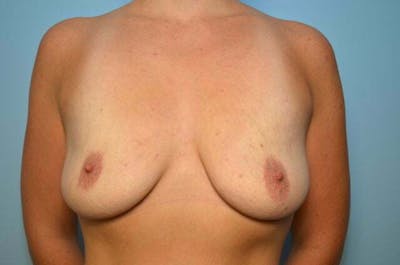 Breast Lift Before & After Gallery - Patient 359784 - Image 1