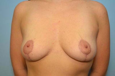 Breast Lift Before & After Gallery - Patient 359784 - Image 2