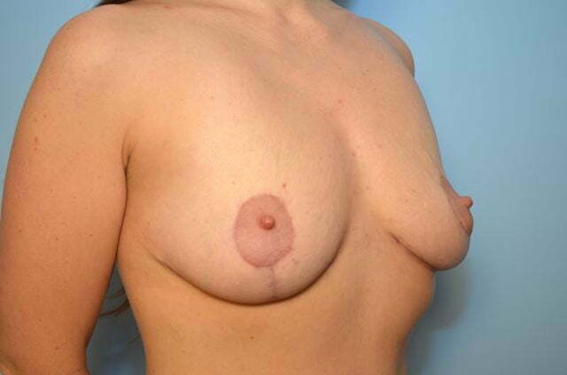 Breast Lift Before & After Gallery - Patient 134634 - Image 4