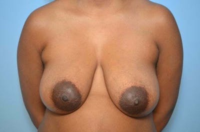 Breast Lift Before & After Gallery - Patient 391764 - Image 1