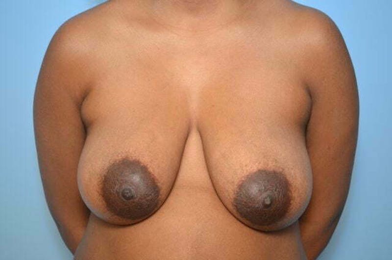 Breast Lift Before & After Gallery - Patient 391764 - Image 1