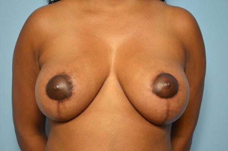 Breast Lift Before & After Gallery - Patient 391764 - Image 2