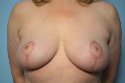 Breast Lift Before & After Gallery - Patient 285903 - Image 2