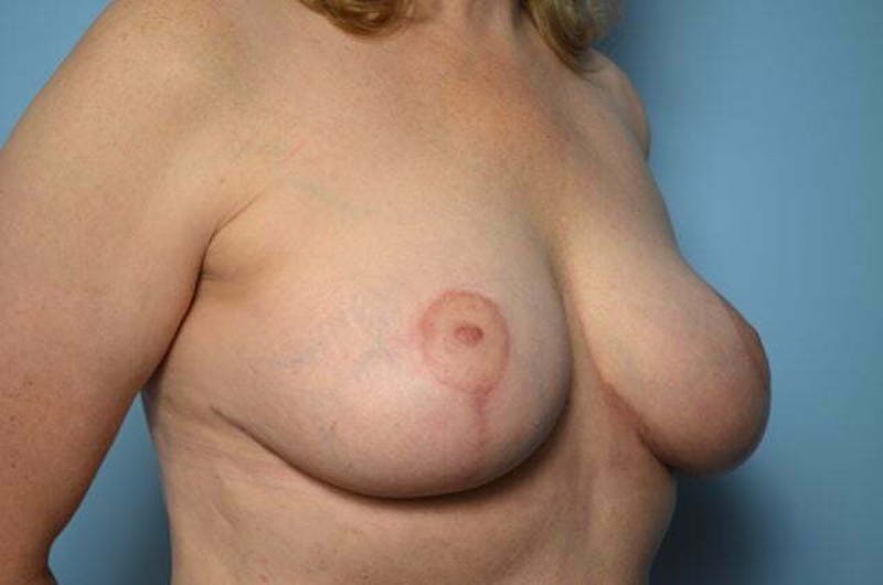 Breast Lift Before & After Gallery - Patient 285903 - Image 4