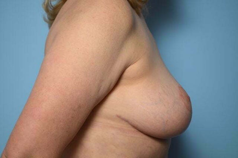 Breast Lift Before & After Gallery - Patient 285903 - Image 6
