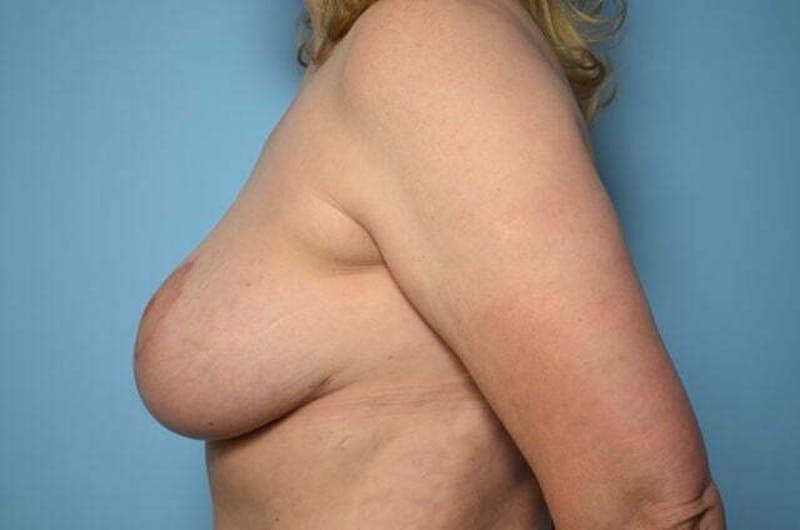 Breast Lift Before & After Gallery - Patient 285903 - Image 10