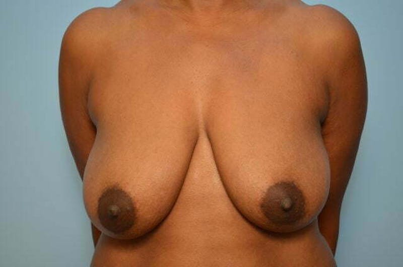 Breast Lift Before & After Gallery - Patient 417122 - Image 1