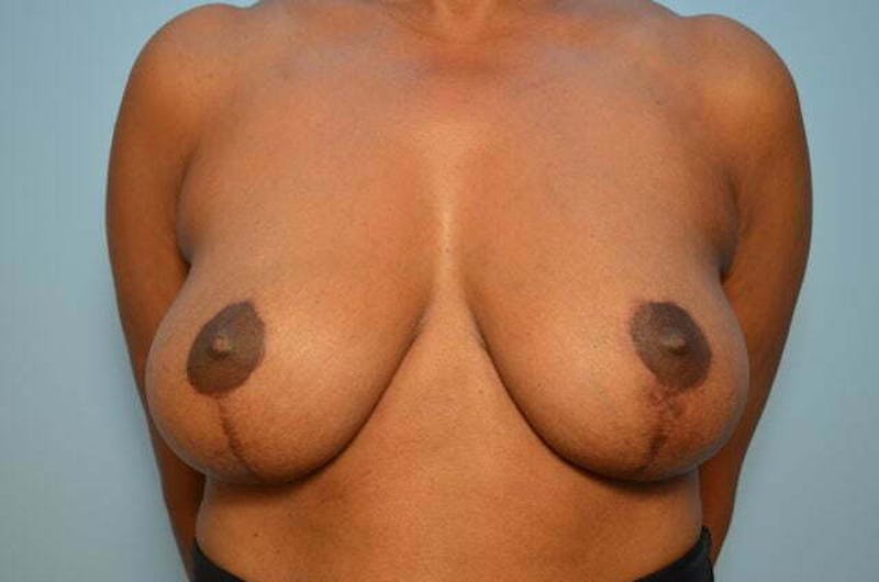 Breast Lift Before & After Gallery - Patient 417122 - Image 2