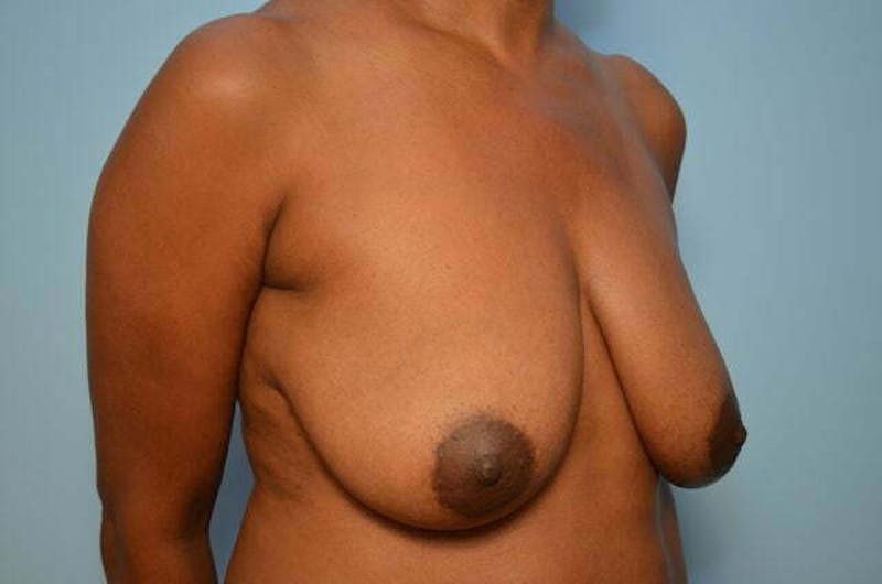 Breast Lift Before & After Gallery - Patient 417122 - Image 3