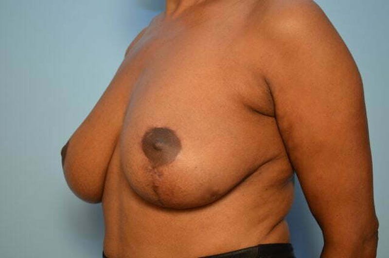 Breast Lift Before & After Gallery - Patient 417122 - Image 8