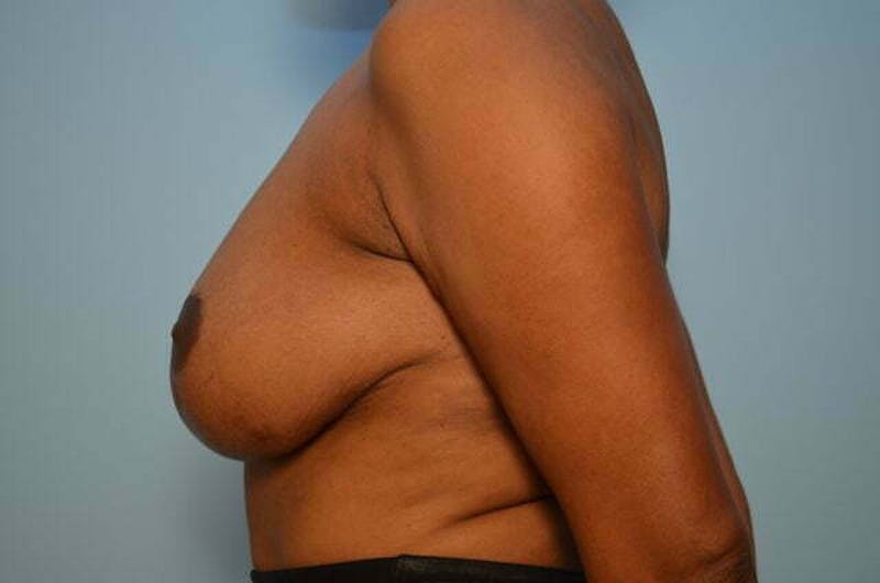 Breast Lift Before & After Gallery - Patient 417122 - Image 9