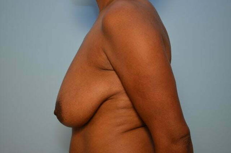 Breast Lift Before & After Gallery - Patient 417122 - Image 10