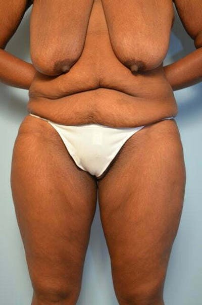 Tummy Tuck Before & After Gallery - Patient 204385 - Image 1