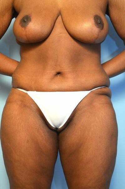 Tummy Tuck Before & After Gallery - Patient 204385 - Image 2