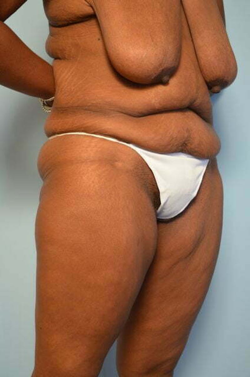 Tummy Tuck Before & After Gallery - Patient 204385 - Image 3