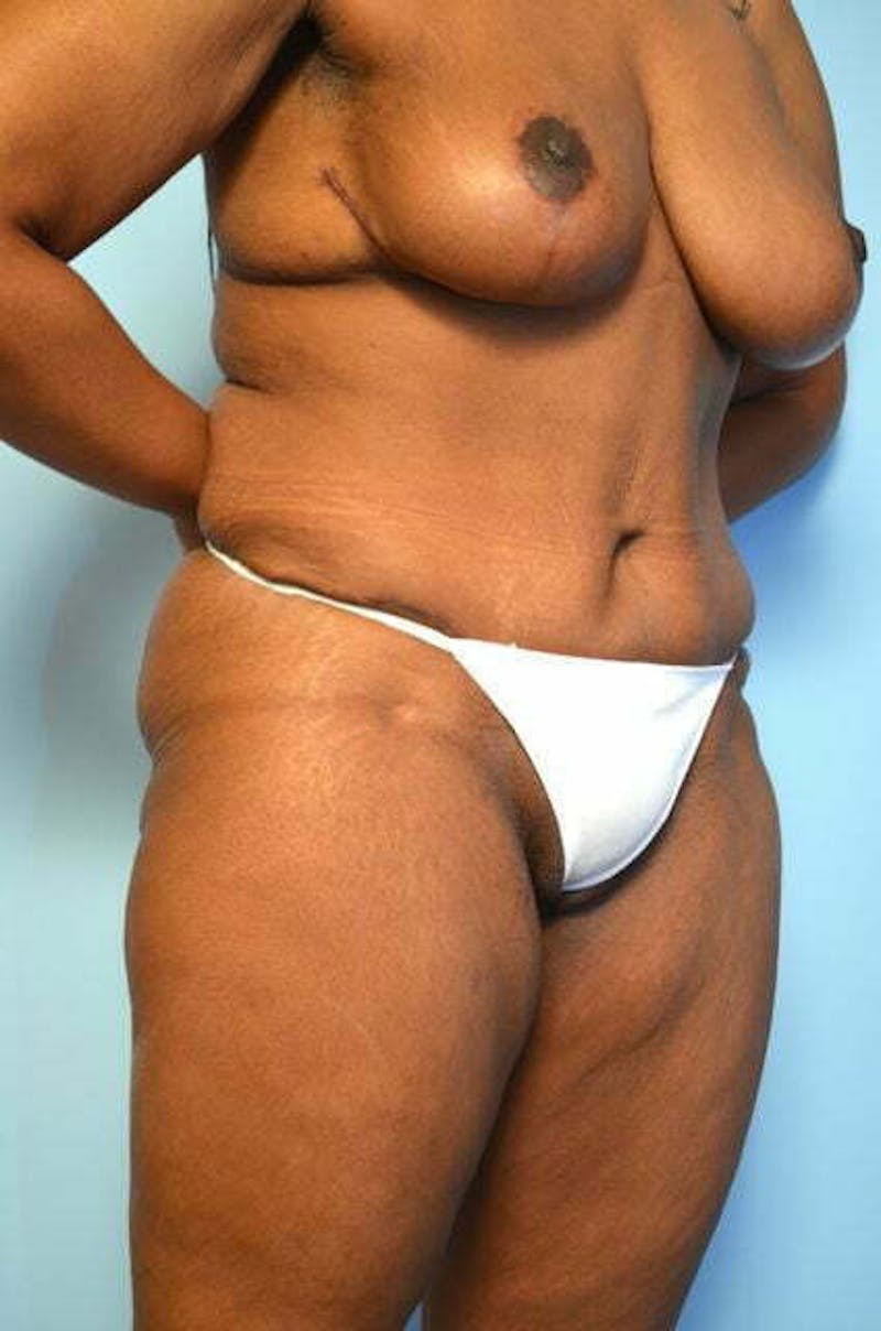 Tummy Tuck Before & After Gallery - Patient 204385 - Image 4