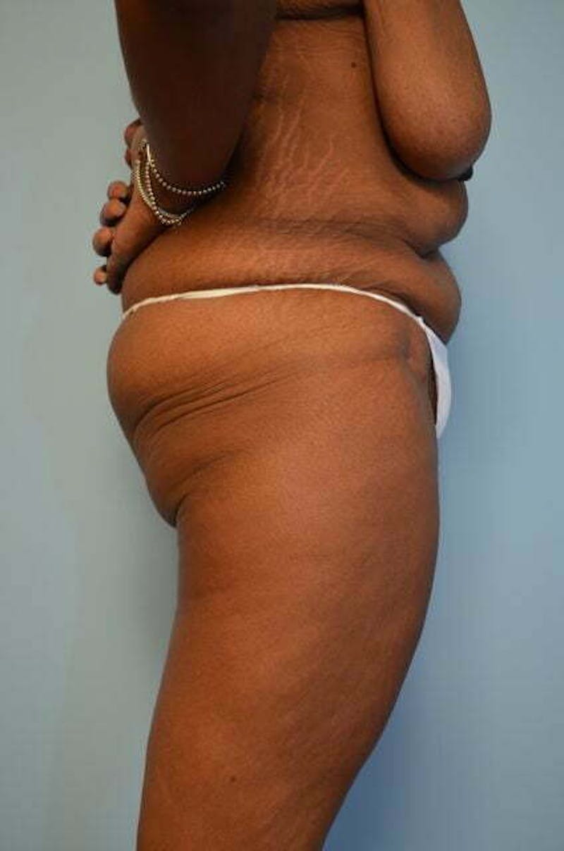 Tummy Tuck Before & After Gallery - Patient 204385 - Image 5