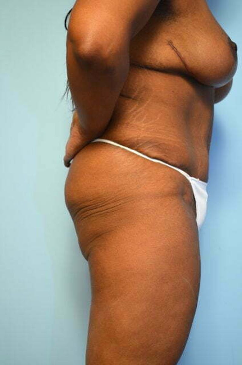 Tummy Tuck Before & After Gallery - Patient 204385 - Image 6