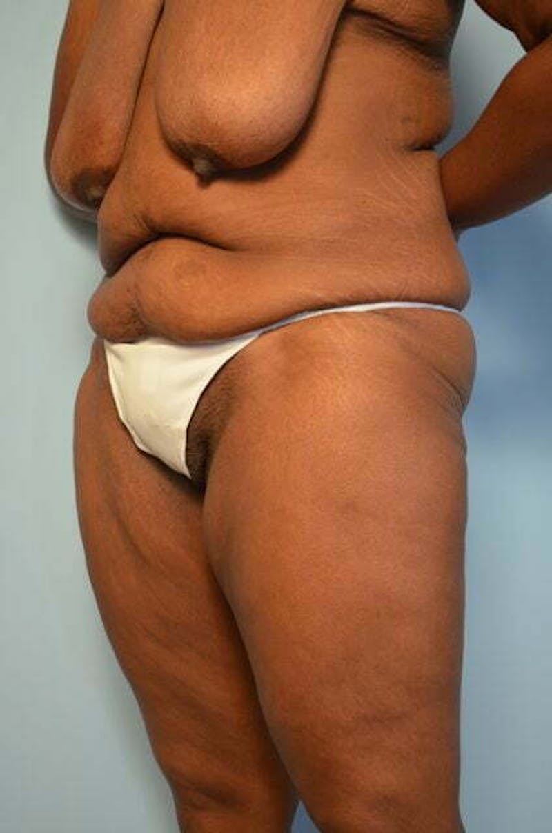 Tummy Tuck Before & After Gallery - Patient 204385 - Image 7