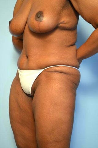 Tummy Tuck Before & After Gallery - Patient 204385 - Image 8