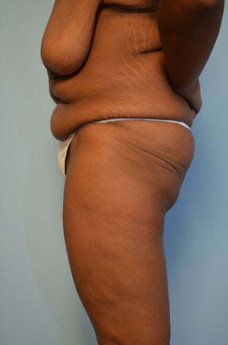 Tummy Tuck Before & After Gallery - Patient 204385 - Image 9