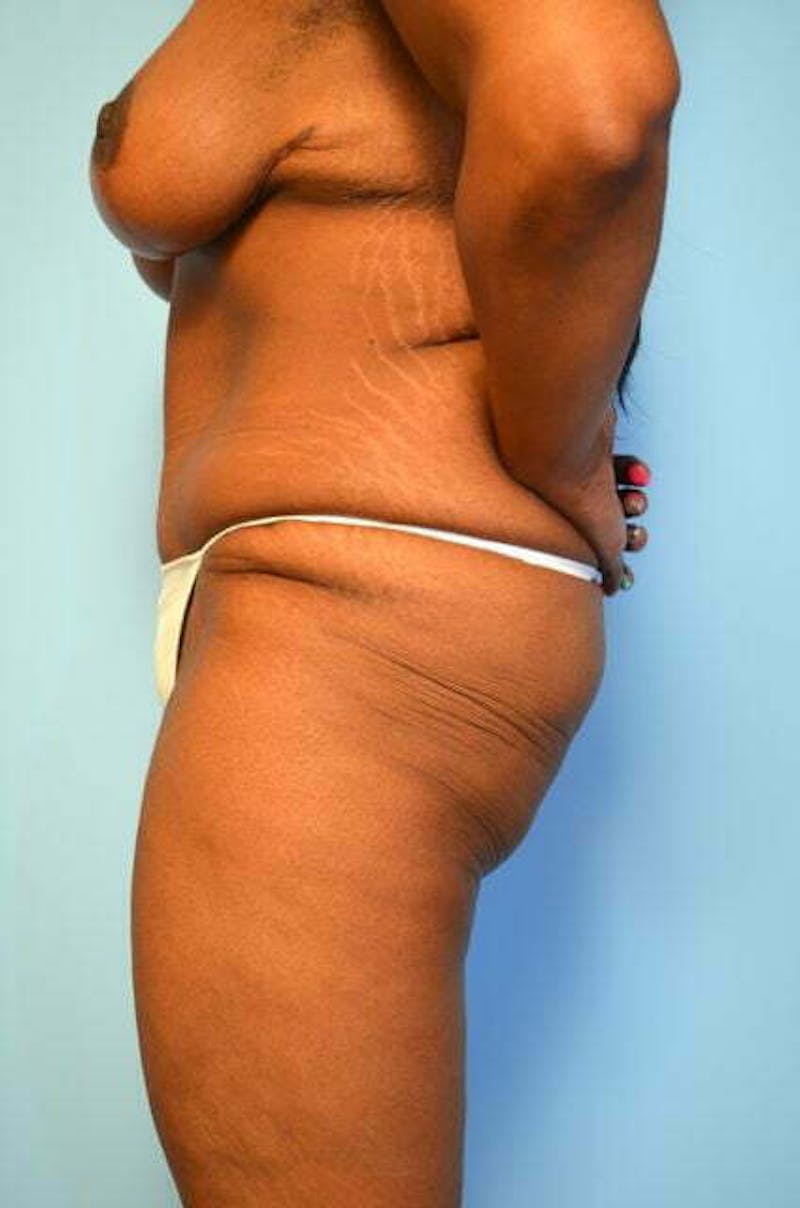Tummy Tuck Before & After Gallery - Patient 204385 - Image 10