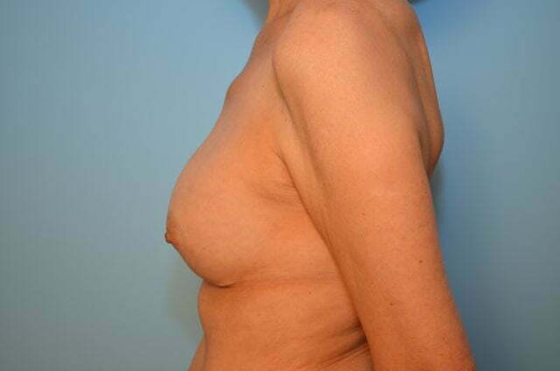 Breast Implant Exchange Before & After Gallery - Patient 225459 - Image 9