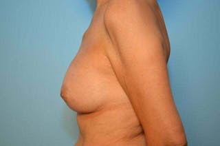 Breast Implant Removal Before & After Gallery - Patient 163259 - Image 10