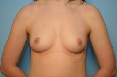 Breast Other Before & After Gallery - Patient 259929 - Image 1