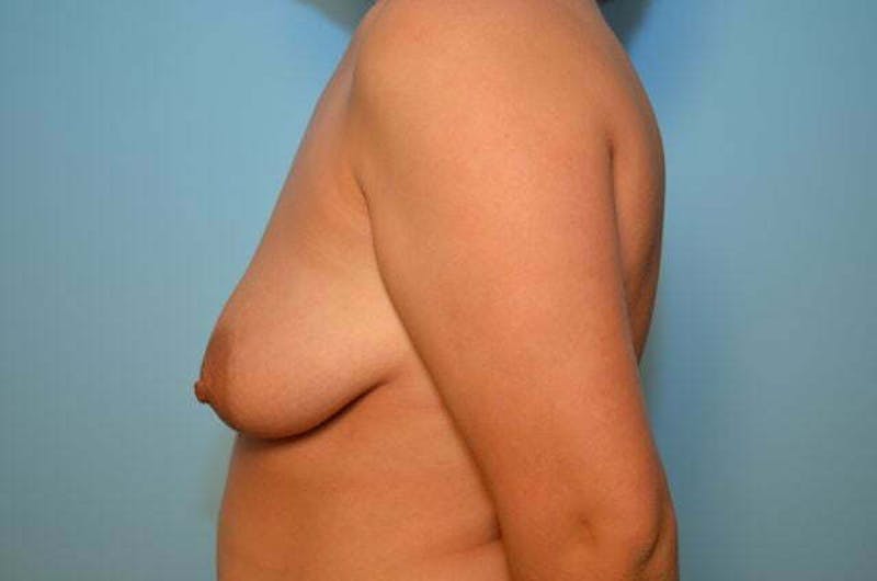 Breast Other Before & After Gallery - Patient 155295 - Image 9