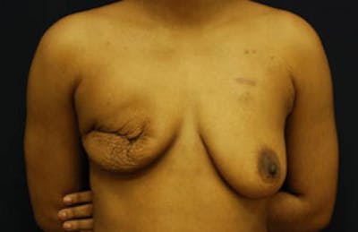 Breast Reconstruction Before & After Gallery - Patient 305866 - Image 1