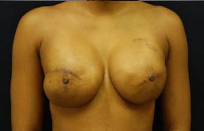 Breast Reconstruction Before & After Gallery - Patient 305866 - Image 2
