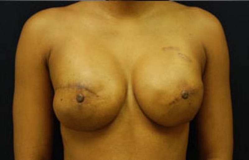 Hidden Breast Reconstruction Before & After Gallery - Patient 305866 - Image 2