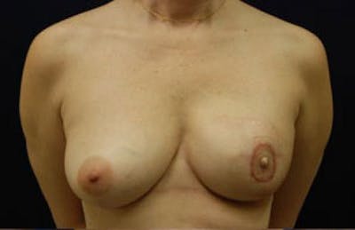 Breast Reconstruction Before & After Gallery - Patient 516593 - Image 2
